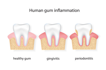  human gum inflammation.